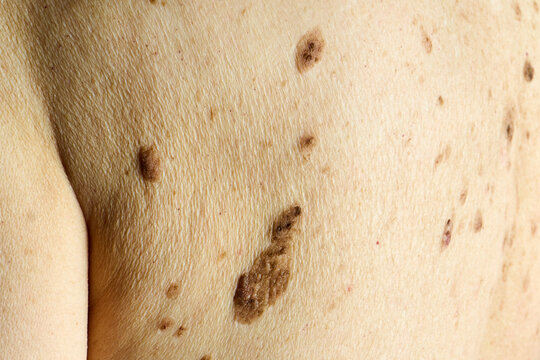 Human skin showing multiple moles and nevus