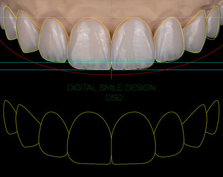 Computer-aided design of porcelain dental veneers in aesthetic dentistry. Digital Smile Design (DSD), computer-designed aesthetic dental applications, zirconium, and glass-ceramic porcelain laminates.