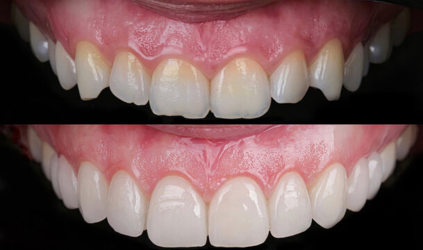Dental smile design and Hollywood smile. Aesthetic treatment of crooked and deformed teeth using porcelain veneers, aesthetic fillings, and zirconium crowns.