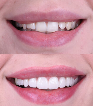 Dental smile design and Hollywood smile. Aesthetic treatment of crooked and deformed teeth using porcelain veneers, aesthetic fillings, and zirconium crowns.