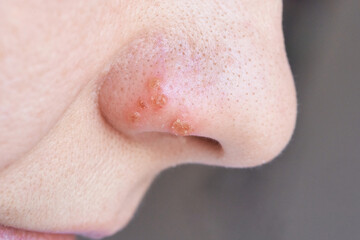 Fototapeta premium Nose Profile With Crusted Scabs And Inflamed Pores On Nostril Closeup Showing Brownish Crusts And Surrounding Textured Skin In Neutral Lighting Clinical Dermatology Context.