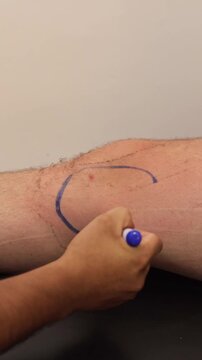 Hand circling a red skin spot with blue marker