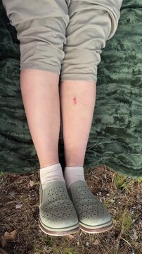 Close-up of woman's legs with red insect bites on picnic blanket in summer forest, skin irritation in nature and outdoor lifestyle