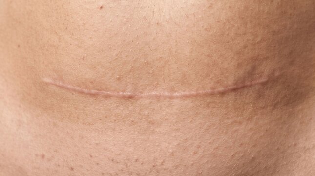 Close up of a healed surgical incision scar on abdomen