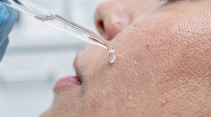 Naklejka premium Close-up of professional serum application on facial skin with pipette for skincare and anti-aging