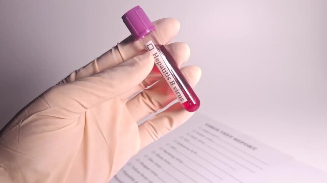 A gloved hand holds a blood sample tube labeled Hepatitis B virus near a medical test report illustrating diagnostic procedures
