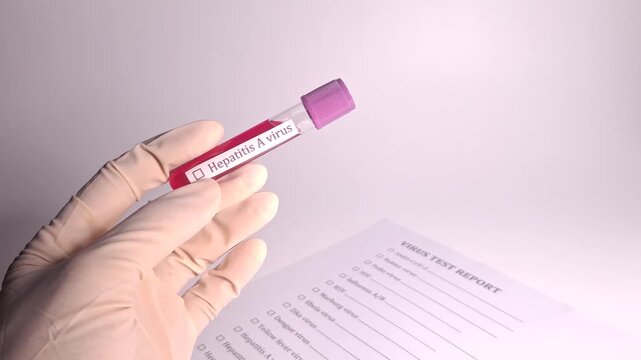 Medical hand wearing a glove holds a blood sample vial labeled Hepatitis A virus next to a virus test report indicating laboratory research