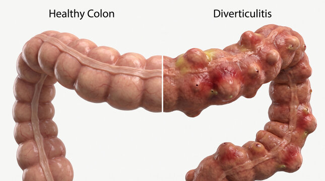 Healthy Colon Versus Diverticulitis Inflamed Intestinal Pouches 3D Medical Illustration