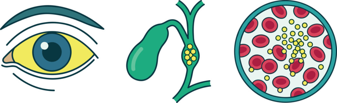 Medical Infographic Icons Showing Jaundice Symptoms and Causes with Yellow Eye Gallbladder Obstruction by Gallstones and High Bilirubin in Blood Cells