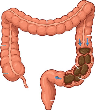 Human Colon Anatomy Diagram Showing Transverse Descending and Sigmoid Parts with Compacted Fecal Mass Obstruction and Strained Intestinal Wall Labels