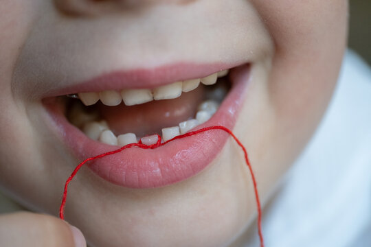 Smiling Child Holding String to Remove Loose Baby Tooth