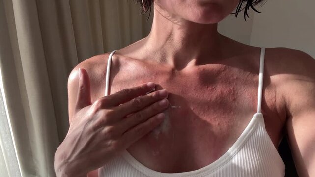 Close-up of a woman applying soothing white calamine cream on her sunburnt decollete with painful erythematous papules and sun allergy rash