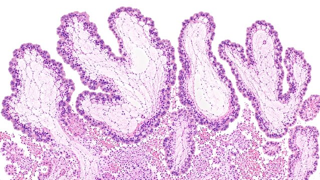 Hydatidiform Mole Histopathology Close-Up, Complete Molar Pregnancy H&E Microscopy Slide