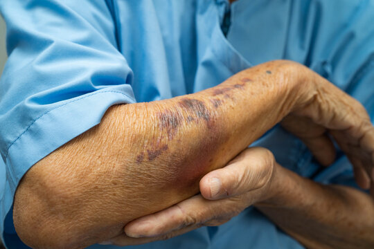 Ecchymosis, elderly bleeding on her arm after taking aspirin.
