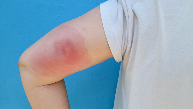 Person wearing a light-colored T-shirt has redness and significant swelling of the skin at the site of an insect bite on their forearm. Severe allergic reaction, inflammation, and skin irritation. 