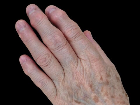 detailn&iacute; l&eacute;kařsk&aacute; fotografie lidsk&eacute; ruky s paličkovit&yacute;mi prsty použit&aacute; pro vzděl&aacute;vac&iacute; a klinick&yacute; v&yacute;zkum ve zdravotnick&eacute; vědě