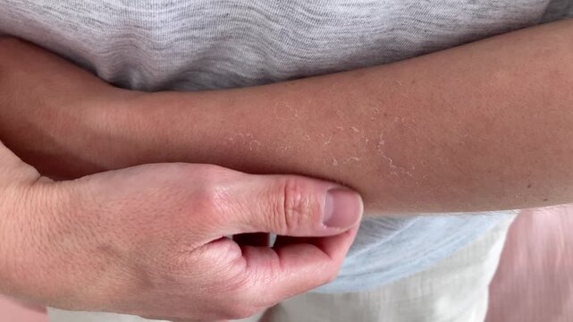 Close-up of the forearm with sunburned skin, peeling, dry skin after sunburn. A woman's hand with the consequence of excessive exposure to ultraviolet rays