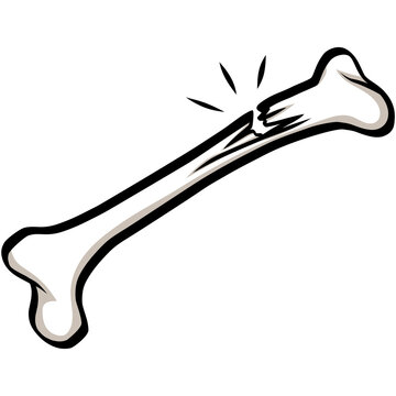Greenstick Fracture Bone Illustration