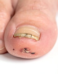 Fototapeta premium Close-up of a diseased toe nail