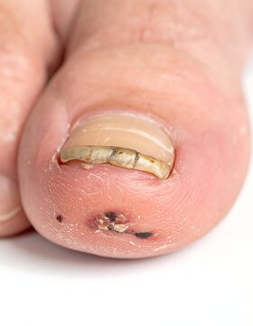 Close-up of a diseased toe nail