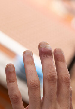 Human finger with painful inflammation and paronychia infection