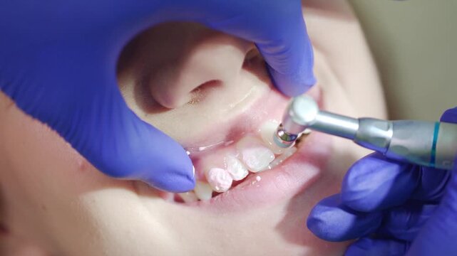 close up of teeth polishing dental procedure using prophy paste