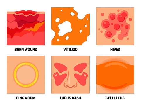 Medical infographic showing common skin conditions including burn wounds vitiligo hives ringworm lupus rash and cellulitis in a flat vector illustration