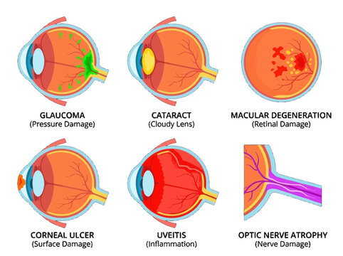 Medical infographic showing common eye diseases and conditions including glaucoma cataract macular degeneration corneal ulcer uveitis