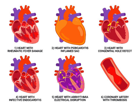 Medical infographic showing various human heart conditions including rheumatic fever pericarditis congenital defects endocarditis arrhythmia