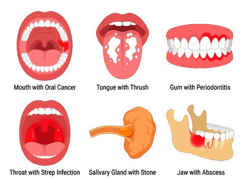 Medical illustration set showing common oral and dental health conditions including infections inflammation and pathologies in human anatomy