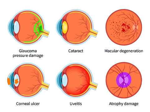 Medical illustration showing common human eye diseases and conditions including glaucoma cataract macular degeneration corneal ulcer uveitis