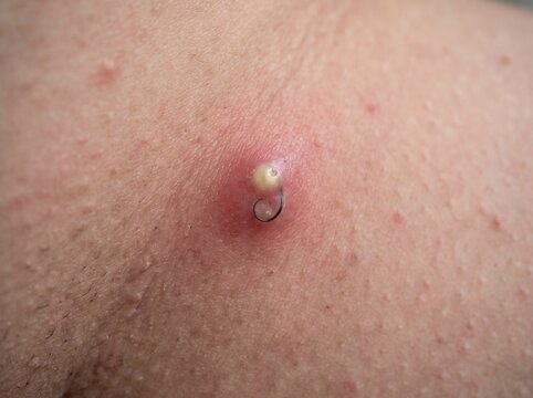 Pictures of a Ingrown Hair Cyst Showing Inflamed Skin Bumps for Medical Education and Clinical Reference Purposes Today