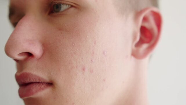 Close-up of a young man&rsquo;s cheek with acne breakouts, skin texture blemishes. Men touching his face with red inflammatory papules. Men&rsquo;s skin care.