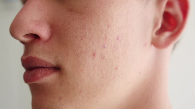 Close-up of a young man&rsquo;s cheek with acne breakouts, skin texture blemishes, and red inflammatory papules. Mam with pimples on his face.