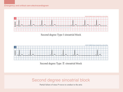 Second degree sinoatrial block refers to a condition in which sinus impulses are only partially conducted to the atria; this results in the appearance of sinus P waves on the ECG, while the blocked co
