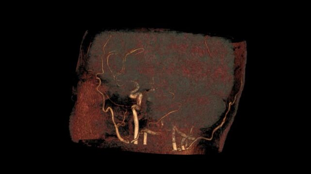 3D MRA Brain Volume Rendering Animation with Rotating Cerebral Blood Vessels for Medical Imaging