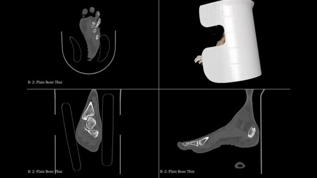 Rotating Left Ankle CT Animation Showcasing Detailed Skeletal Anatomy for Diagnosis