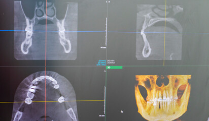 Dental cone beam computed tomography or CBCT diagnostic scan software displaying multi-planar views and a 3D maxillofacial reconstruction model. Healthcare © Four_Lakes