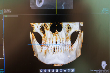 Close-up of a 3D maxillofacial bone reconstruction displayed on dental cone beam computed tomography diagnostic software. dental © Four_Lakes