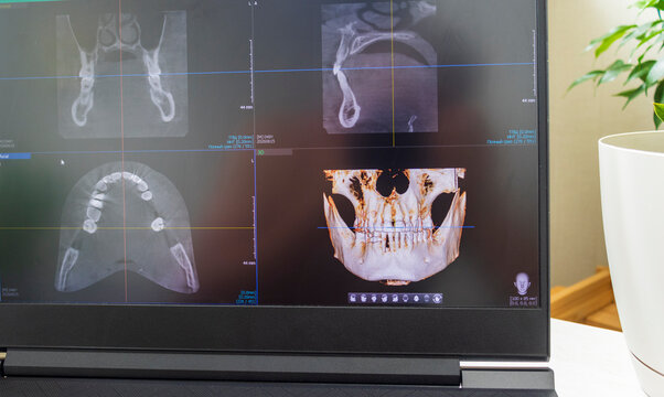 Dental cone beam computed tomography or CBCT diagnostic scan software displaying multi-planar views and a 3D maxillofacial reconstruction model. Healthcare