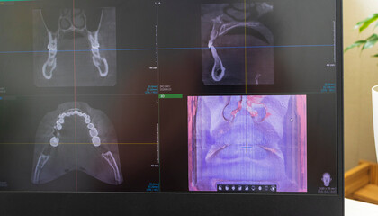 Dental cone beam computed tomography or CBCT diagnostic scan software displaying multi-planar views and a 3D maxillofacial reconstruction model. Healthcare © Four_Lakes