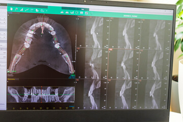 Dental cross-sectional slice sequences and panoramic reconstruction path on a cone beam computed tomography diagnostic monitor. Dental © Four_Lakes