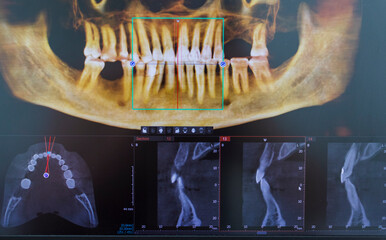 Dental cone beam computed tomography or CBCT diagnostic scan software displaying multi-planar views and a 3D maxillofacial reconstruction model. Healthcare © Four_Lakes