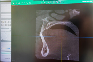 Dental CBCT software interface featuring a 3D volumetric maxillofacial reconstruction alongside axial, sagittal, and coronal multi-planar slices. dental © Four_Lakes