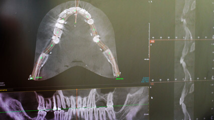 Dental CBCT software interface featuring a 3D volumetric maxillofacial reconstruction alongside axial, sagittal, and coronal multi-planar slices. dental © Four_Lakes