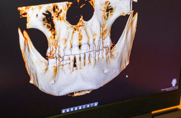 Dental CBCT software interface featuring a 3D volumetric maxillofacial reconstruction alongside axial, sagittal, and coronal multi-planar slices. dental © Four_Lakes