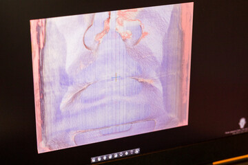 Close-up view of a dental computer diagnostics monitor displaying a specialized 3D volumetric tissue rendering and soft tissue bone scan. Dental © Four_Lakes