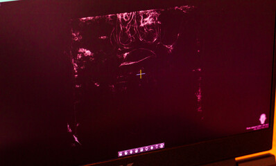Close-up of a dark diagnostic monitor displaying specialized pink 3D soft tissue filtration data from a dental maxillofacial cone beam computed tomography scan. Dental © Four_Lakes