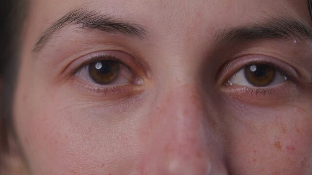 Young Woman bacterial eye infection - extreme close up on face