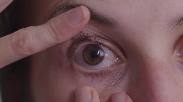 Woman with severe bacterial eye infection with white dots on cornea holds open eye towards camera